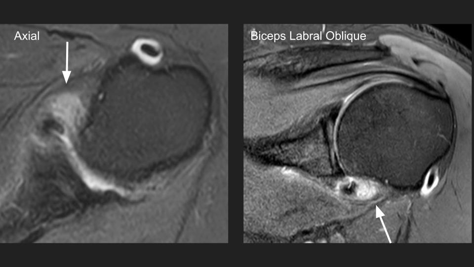 Figure 2 for case adhesive capsulitis